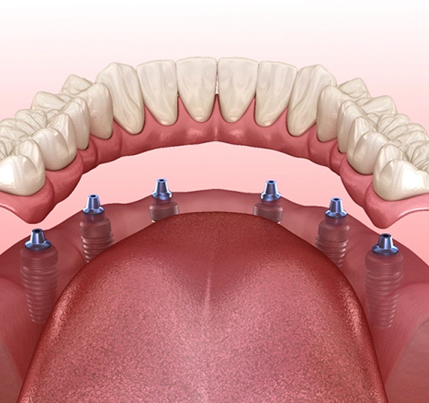 Dentures for lower arch on six dental implants