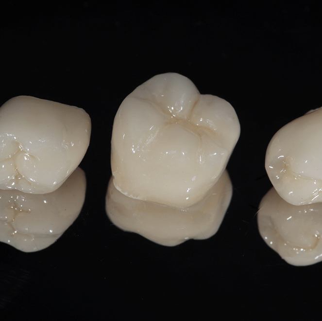 Three porcelain dental crowns sitting on a reflective surface