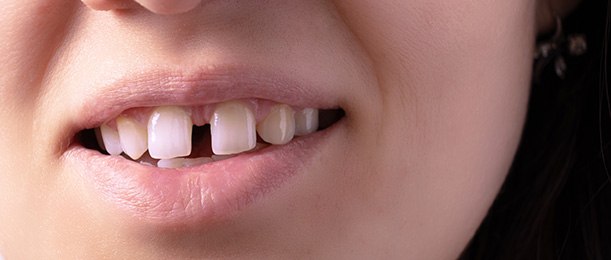 Nose-to-chin closeup of person with wider gap between front teeth