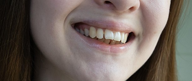 Nose-to-neck view of woman with more severe overbite