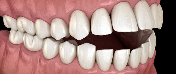 3D rendering of an open bite with black background