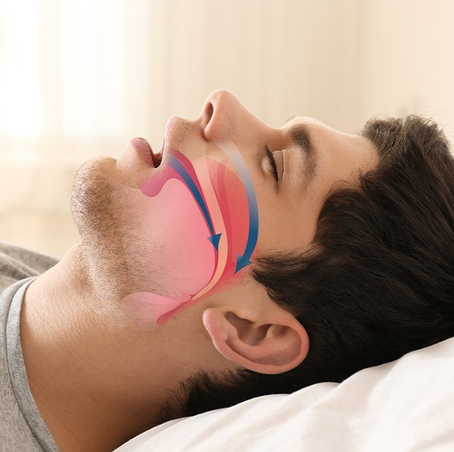 Man sleeping with animated airway across profile