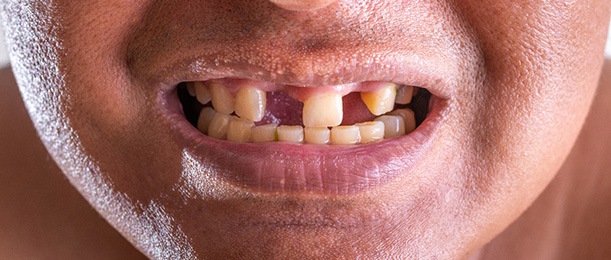 A closeup of a mouth with missing teeth