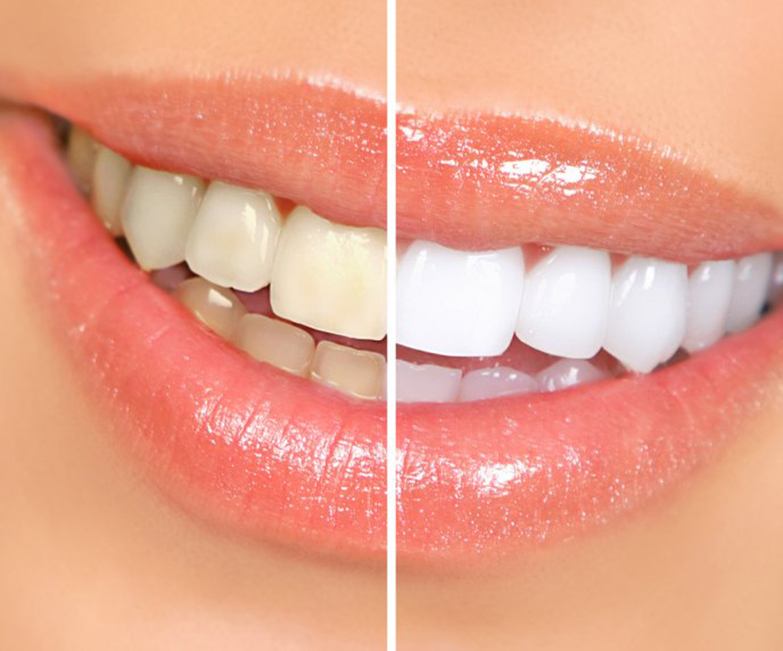 Before and after teeth whitening